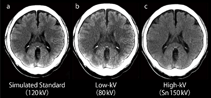 図3　急性期脳梗塞における120kV相当のCT画像Low-kV画像，High-kV画像の比較