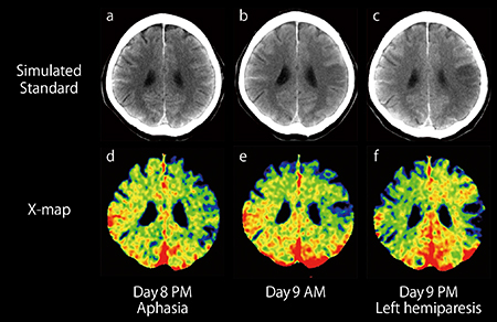 図7　X-mapによるくも膜下出血の脳血管攣縮の描出 X-mapではCT画像で確認できない脳の微妙な変化を強調して描出していると考えられる。