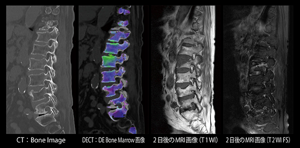 腰椎圧迫骨折評価におけるBone Marrow解析の有用性