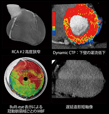 1管球CTによる包括的心臓検査