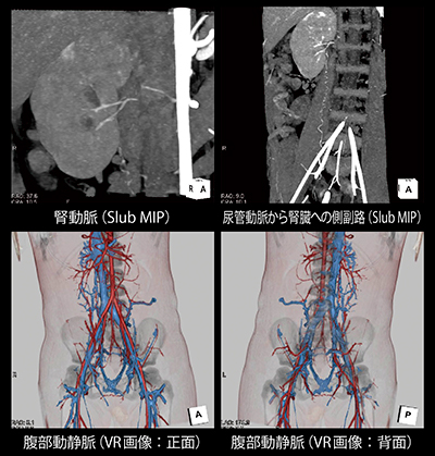 腎移植前小児患者に対する包括的全腹部動静脈撮像