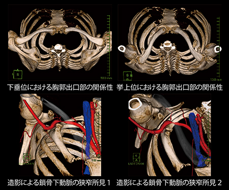 第一肋骨奇形による胸郭出口症候群におけるCTの有用性