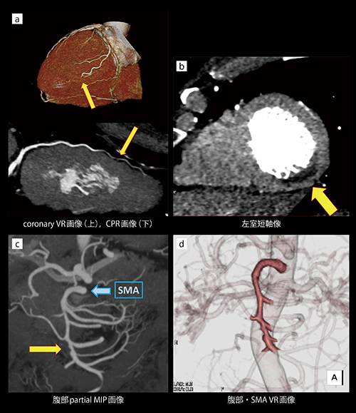 冠動脈解離とSMA解離を同時に描出できた緊急造影CT