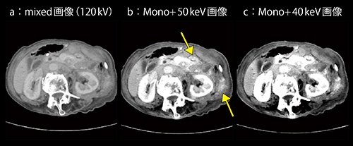 図3　症例3：胃がんの多発性腹膜播種