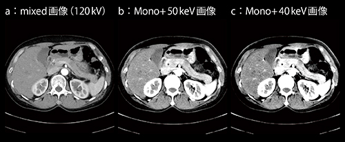 図6　症例6：膵がん（疑い） 3mm，WL/WW40/300