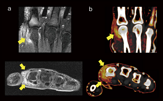 図5　症例2：PsA（64歳，女性，乾癬歴11年） a：MRI　脂肪抑制造影T1強調画像 b：DECTのヨードマップ画像