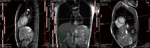 図2　‌AutoAlign Heartによる心臓撮像断面の自動位置決め例