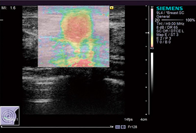 図1　VTIによる組織弾性イメージ：ARFI Imaging（乳頭腺管癌）