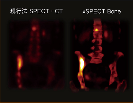 図3　肺がん転移（xSPECT Bone） ジョンズホプキンス大学提供