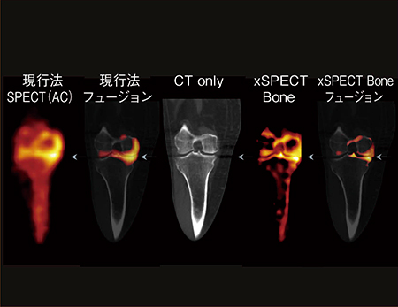 図4　変形性右膝関節症（xSPECT Bone） フリードリッヒ・アレクサンダー大学提供