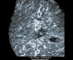 図2　ABVSによる冠状断面（非浸潤性乳管癌）