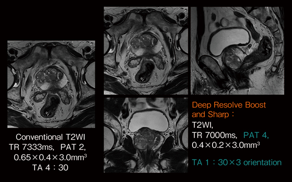 図2　前立腺T2WI conventional TSEとDeep Resolve TSEの比較