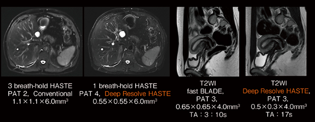図4　腹部，骨盤部におけるDeep Resolve HASTEの活用例