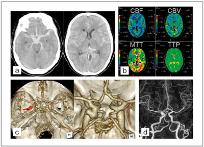 図5　重症くも膜下出血における3D-CT Angiography + CT Perfusion