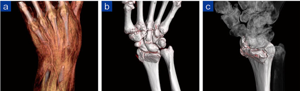 外傷にて救急外来搬送され、手関節を含めた上腕骨の0.5mmスライス撮影を行った症例（a）。Vitreaにて、手根骨（b）と橈骨（c）にボリュームを分けて処理した。