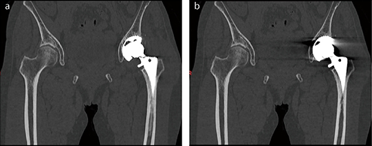 a：SEMARあり、b：SEMARなし 金属アーチファクト低減により、骨頭側だけでなくカップ側の骨の評価も可能となる。