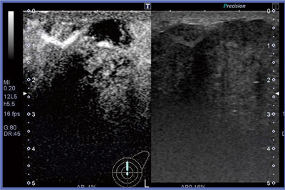 図2　triple negative進行がんの主病変の造影超音波画像