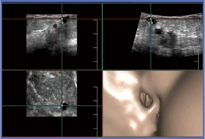 図22　乳管内のFly Thru画像