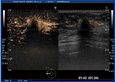 図4　症例1：24mmの硬癌の造影超音波 Aplio XGとPLT-805AT使用