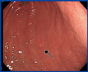 図3　‌微小胃がん（4mm×3mm）の内視鏡画像