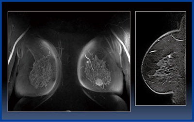 図1　MRIでしか見えない乳がん
