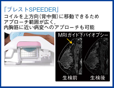 図3　乳房専用コイル「ブレストSPEEDER」