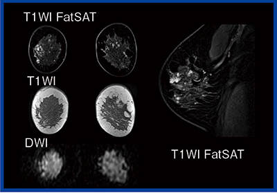 図4　Enhanced Fat Free法で撮像した乳房MRI（8ch）