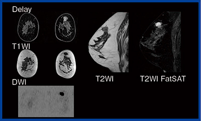 図5　Enhanced Fat Free法で撮像した乳房MRI（8ch）