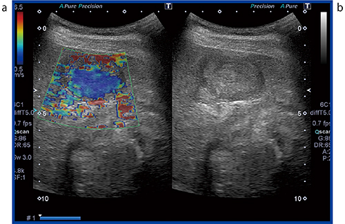 図2　症例1：SWEのカラーマッピング画像（a） 腫瘍内部は周辺の肝硬変に比べて軟らかいことがわかる（腫瘍内部8.6kPa）。