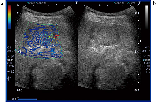 図3　症例1：図2の等高線表示（a） 等高線の密度が腫瘍内部は周辺の肝硬変部に比べて密となり，SWの伝播速度が遅いことがわかる。
