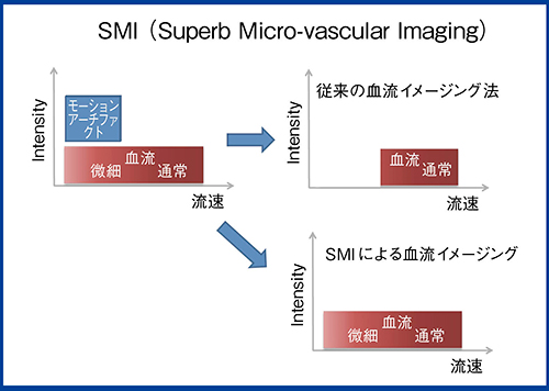 図3　低流速血流を高分解能に描出するSMI
