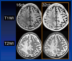 図1　髄膜腫症例における32chヘッドSPEEDERと16ch head coilの比較