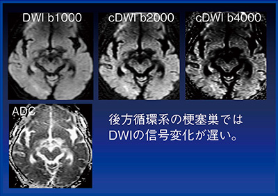 図4　Case1：右側頭後頭葉のDWI，ADCとcDWI