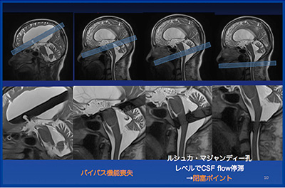 図6　Case3：閉塞性水頭症にてETV施行後CSF flowイメージ