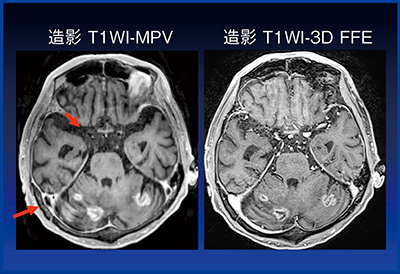 図10　Case5：脳転移症例の造影T1WI-MPVと造影T1WI-3D FFE