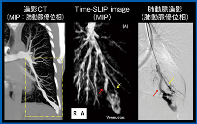 図3　症例1：肺動静脈奇形（未治療病変，40歳代，女性）