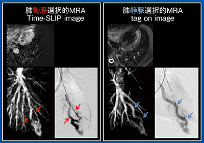 図4　症例1の肺動脈・肺静脈選択的画像