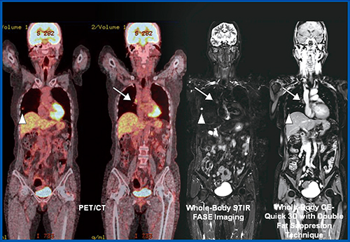 図2　73歳，女性，肺腺癌患者（pT1aN1M0：pStage IIA）のFDG-PET/CTおよびWB-MRI