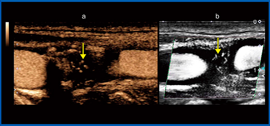 図3　症例1の反対側血管の頸動脈プラーク（長軸画像） a：造影超音波画像，b：SMI画像