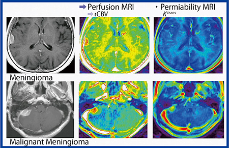 図1　髄膜腫（meningioma）と悪性髄膜腫（malignant meningioma）の比較