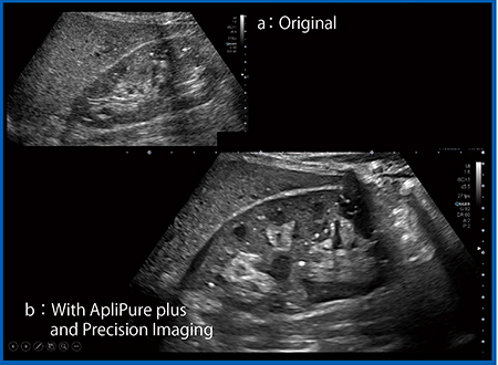 図7　ApliPure plusとPrecision Imaging（b）による腎臓内のびまん性石灰化の描出