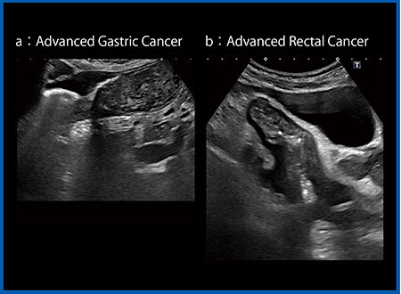 図8　ApliPure plusとPrecision Imagingによる進行胃がん（a）および直腸がん（b）の描出