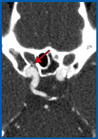 図2　Aquilion Precisionによる内頸動脈の眼動脈起始部動脈瘤の画像（軸位断像）