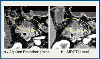 図1　症例1：膵頭部癌における腫瘍の境界・進展の評価