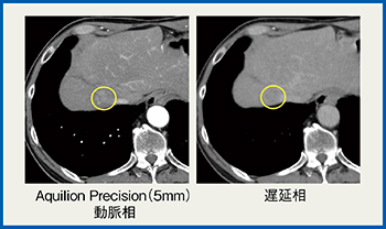 図4　症例4：肝細胞癌TACE施行症例の術前造影CT画像