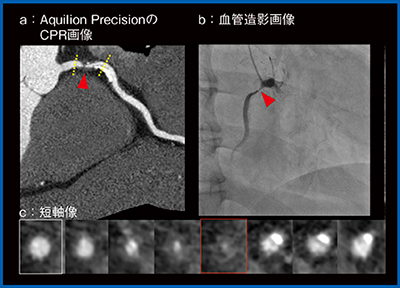 図3　症例2：右冠動脈起始部の高度狭窄におけるAquilion Precisionと血管造影の比較