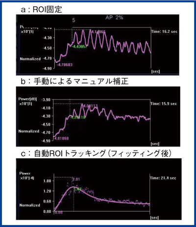 図2　肝細胞がんに対するソナゾイド造影超音波検査によるTIC（時間輝度曲線）