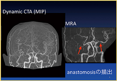 図1　Case1：中大脳動脈の右閉塞，左狭窄 Dynamic CTAでは末梢まで描出されている。