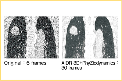 図2　AIDR 3DとPhyZiodynamicsによる動態撮影の画質向上
