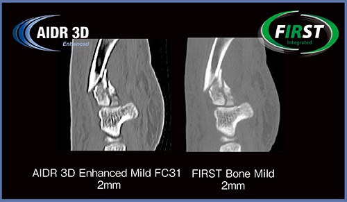 図1　骨折症例におけるAIDR 3D EnhancedとFIRSTの比較